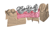 Charger l&#39;image dans la galerie, Implant Module Exocad